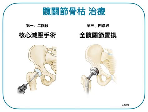 骨枯手術費用|【髖關節手術】即睇原理、副作用及詳細步驟+收費參。